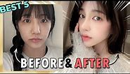 5 AMAZING Korean Plastic Surgery Transformation |Dramatic Makeover Before and After Results in Korea