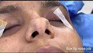 Boxy Nose Job with tip plasty and rhinoplasty