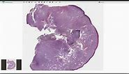 Mucosal Melanoma - Histopathology