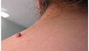 How to Remove Regular Skin Tags / Wart & Mole Vanish