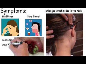 Infectious mononucleosis - Easy explained