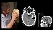 Paranasal sinuses CT imaging anatomy