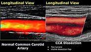Carotid Artery Color/Spectral Doppler Ultrasound Normal Vs Abnormal Images | ICA Stenosis USG