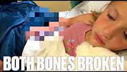 SEVEN-YEAR-OLD BREAKS BOTH BONES IN HER RIGHT ARM ON THE FIRST DAY OF SUMMER BREAK | BOTH ARM BONES