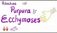 Petechiae, Purpura and Ecchymoses