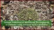 Our Natural Treatment of Molluscum Contagiosum in Children