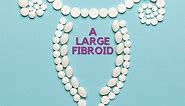 What Is Considered a Large Fibroid? Fibroid Size Chart