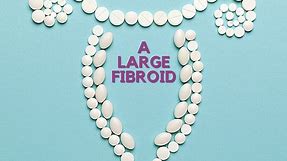 What Is Considered a Large Fibroid? Fibroid Size Chart