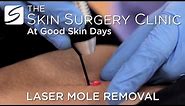 Laser Mole Removal | Watch the Procedure