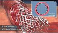 3D Medical Animation of Coronary Stent Procedure