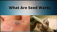 What Are Seed Warts