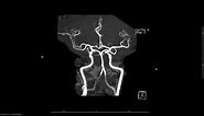MRA (magnetic resonance angiogram) head radiology search pattern