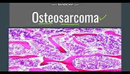 Osteosarcoma: General,Morphology, Subtypes,Clinical features