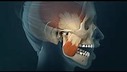 TMJ Pain: Headaches, Earaches and Spasms