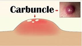 Carbuncle - Causes, Signs & Symptoms, Risk Factors, Diagnosis, & Treatment