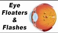 Eye Floaters: What Are They & What Causes Them?