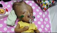 Toddler with Birth Defects 'Incompatible with Life' Defies Odds in Venezuela
