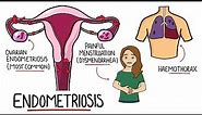 Endometriosis Explained (Signs & Symptoms, Diagnosis, Pathology, Treatment)