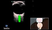 How to: Ocular Ultrasound 3D Video