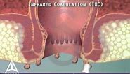 Anal warts & infrared coagulation treatment - 3D animation