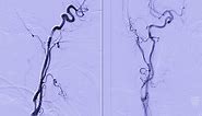 Carotid artery with stenosis — Diagnostic and treatment advancements - Mayo Clinic
