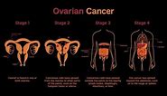 Treatment of Invasive Epithelial Ovarian Cancers by Stage