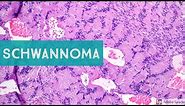 Schwannoma (Neurilemmoma)...Explained by a Soft Tissue Pathologist