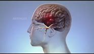 What Happens In Your Body During Migraine | WebMD