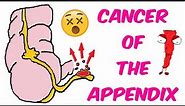 Cancer of the Appendix! All the basics!