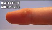 How to Get Rid of Warts on Fingers