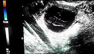 Ultrasound Diagnosis of Complex Ovarian Cyst