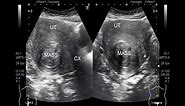 Ultrasound Video showing Two videos of Fibroids Uterus.