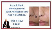 Face & Neck Mole Removal with Aesthetic Scars: No Cutting, no Stitches