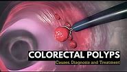 Colorectal Polyps, Causes, Signs and Symptoms, Diagnosis and Treatment.