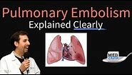 Pulmonary Embolism Explained Clearly - Risk factors, Pathophysiology, DVT, Treatment