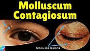 Molluscum Contagiosum (Water Warts) – Symptoms, Causes, Diagnosis, Treatment & Complications
