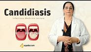 Candidiasis | Infectious Medicine Video Lectures | Online Medical Education | V-Learning
