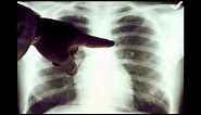 Lung Cancer X-ray