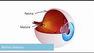 Retinal diseases: Causes, symptoms, diagnosis & treatment. Essentials in 3 minutes. Eye surgery.