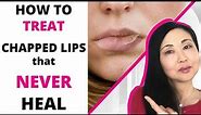 How to TREAT Chapped Lips that never heal (Actinic Cheilitis-4 GRADES)