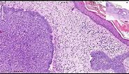 Basal Cell Carcinoma Including Variants - Histopathology