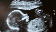 When can I find out my baby's gender?