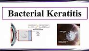 Bacterial Keratitis