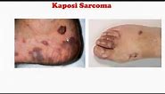 Kaposi sarcoma