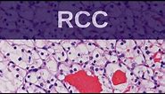 Renal Cell Carcinoma - Pathology mini tutorial
