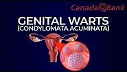 Genital Warts (Condylomata Acuminata)