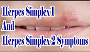 Herpes Simplex 1 And 2 Symptoms : Which Herpes You Are Suffering From HSV 1 Or HSV 2