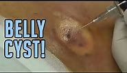 The Tummy Cyst - Busted!