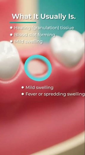 🦷 Soft Lump on Your Gum After an Extraction?