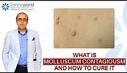 What is Molluscum Contagiosum | Cure for Molluscum Contagiosum | Dr. Rohit Batra
